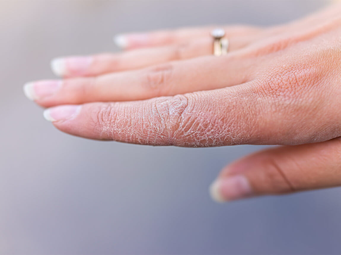 Suchá kůže na rukou 
