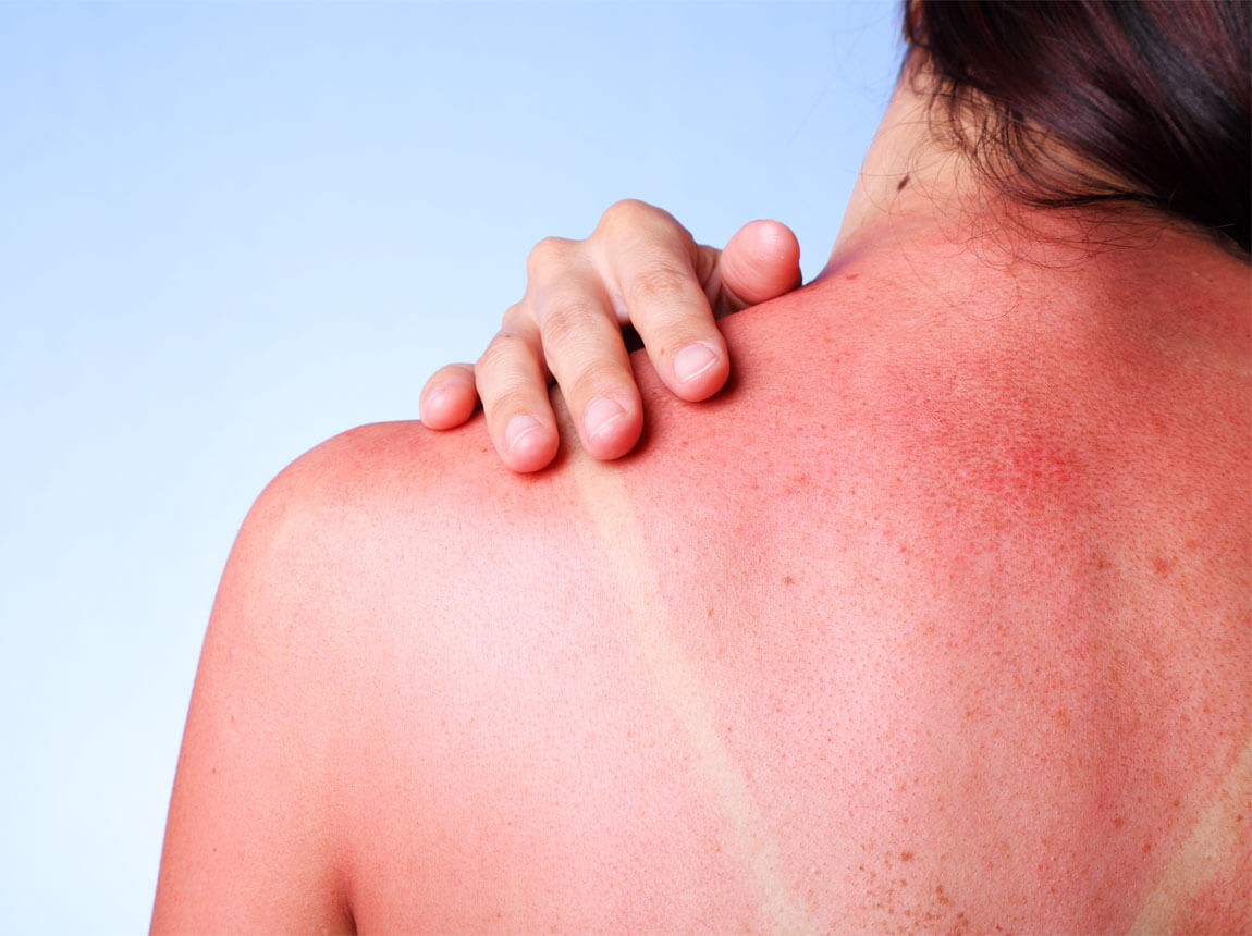 opaření sluncem - popáleniny na kůži