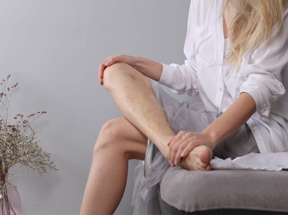 žena - křečové žíly na nohou 