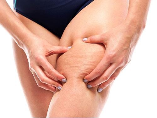 Pomůže kofein v boji proti celulitidě?