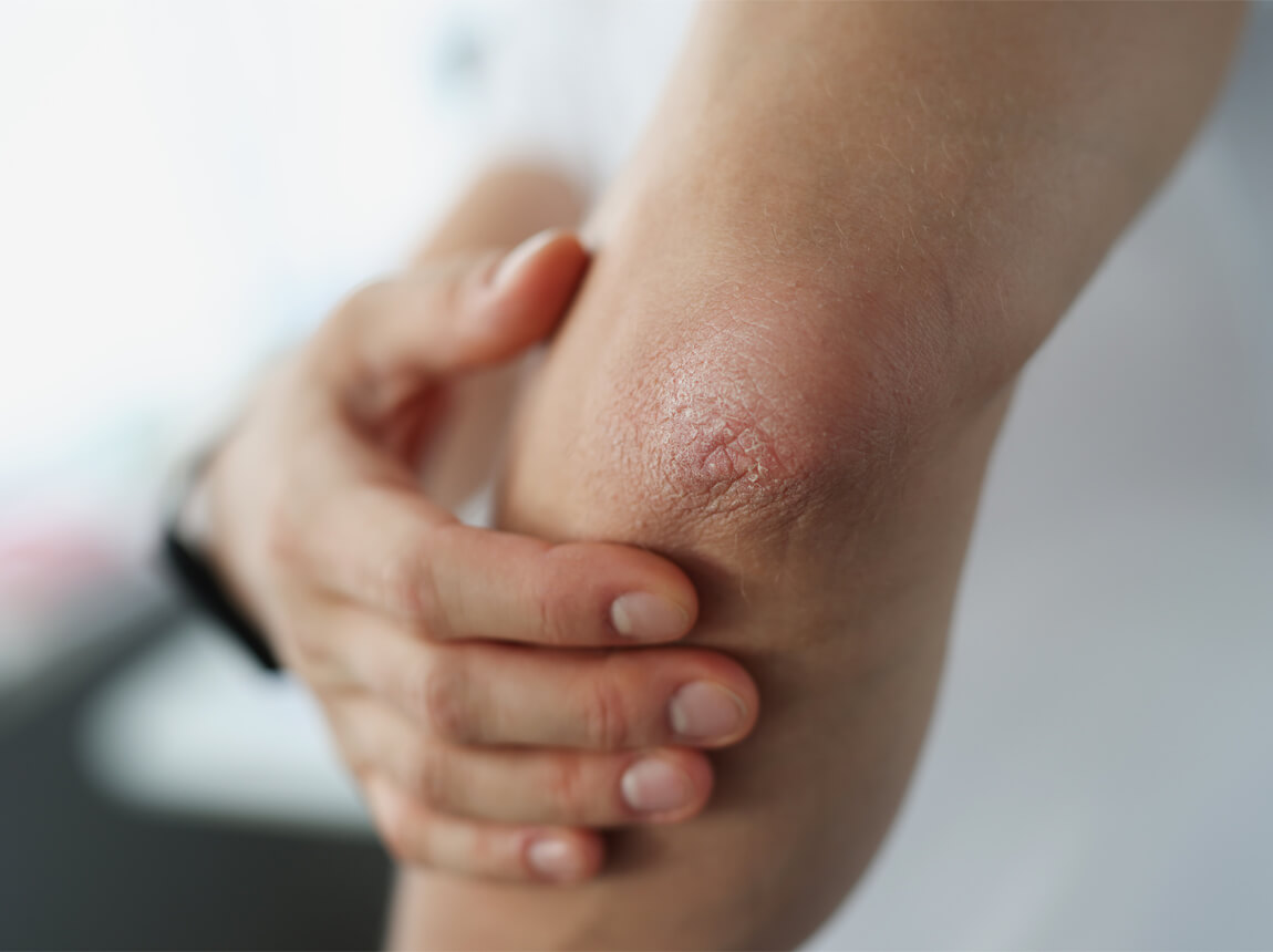 suchá kůže na loktech 